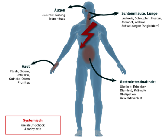 Bild von Pathogenesis and diagnosis of type I allergy