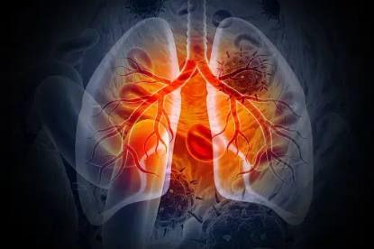 Bild von Tuberculosis